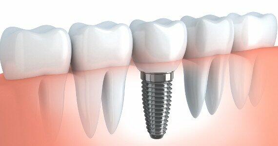 Dental Implant Procedures