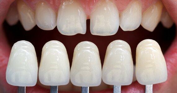 Teeth Veneers