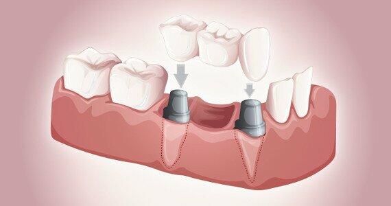 Dental Bridges