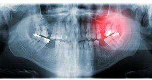 periodontitis bradford