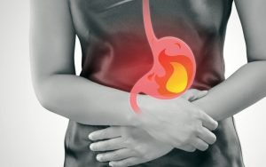 Acid Reflux Image