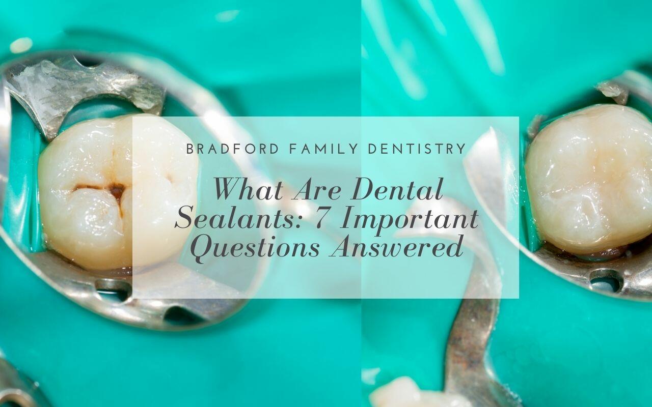 What Are Dental Sealants 7 Important Questions Answered Bradford