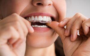 Invisible-Clear-Aligners-Bradford-Dentist