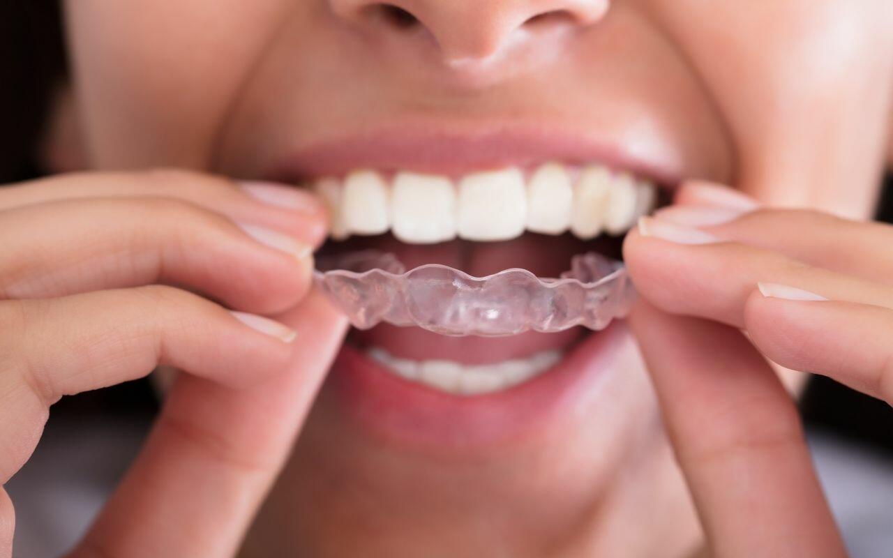 clear aligners - Bradford Family Dentistry