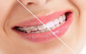 ultimate-guide-to-braces-Bradford-Dentistry