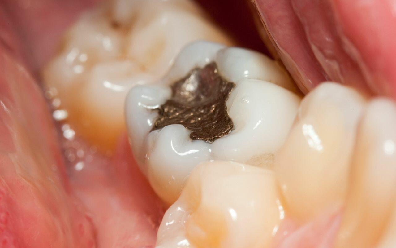 amalgam-fillings-Bradford-Family-Dentistry