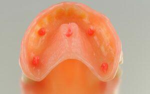 A tooth model displaying red dots indicating a denture issue.