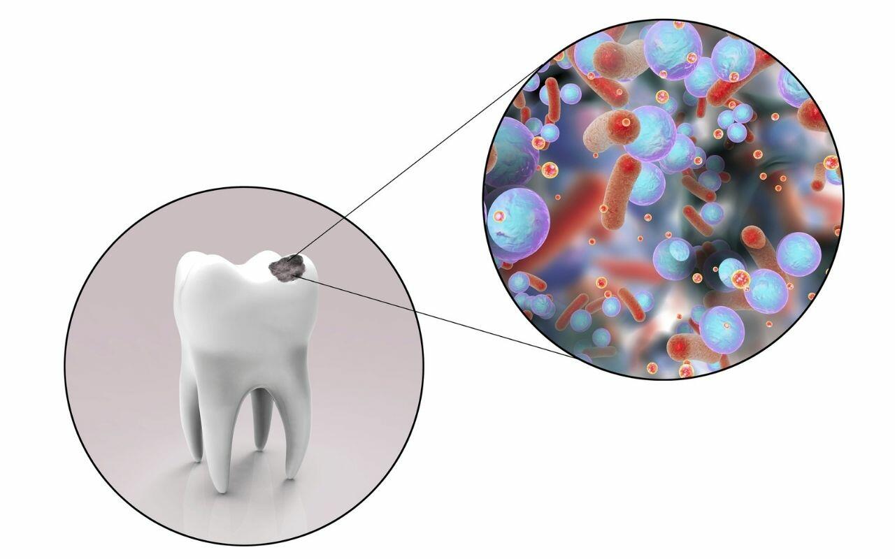 what-is-tooth-decay-Bradford-Family-Dentistry