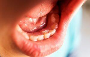 A close up of a child's mouth showcasing common childhood dental problems.