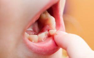 over-retained-primary-teeth-is-common-childhood-dental-problem-Bradford-Dentist