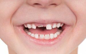 A close up of a child's missing teeth highlighting common childhood dental problems.