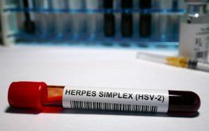 Blood test tube, herpes simplex virus 2 (HSV-2).