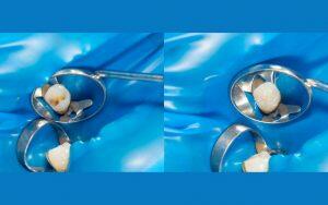 Two contrasting images comparing different types of dental fillings for a tooth.