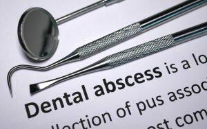 Dental abscess is a long list of dental tools that address the danger of tooth decay.