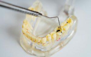 A model of a tooth displaying the different types of dental fillings available, highlighting their pros and cons.