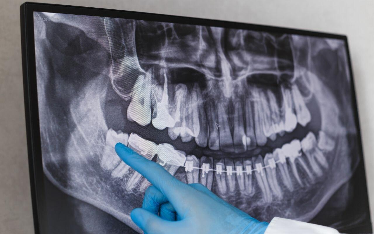 complications-of-impacted-wisdom-teeth