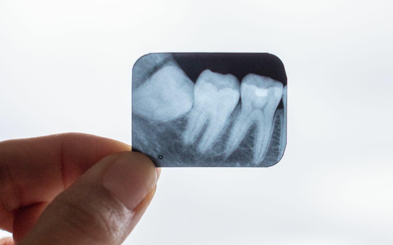 can-impacted-wisdom-teeth-be-prevented