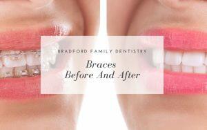 braces-before-and-after-Bradford-Family-Dentistry-Orthodontics