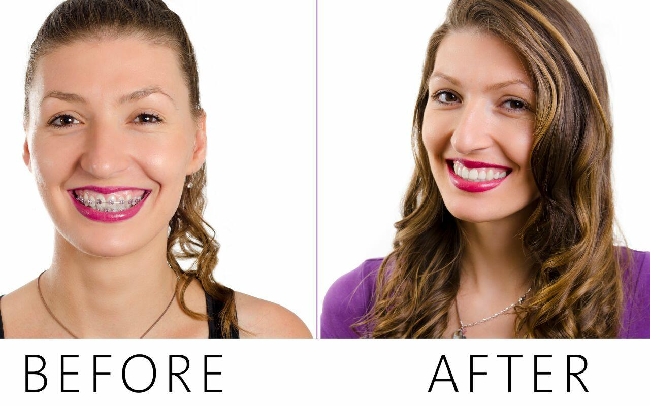 braces-before-and-after