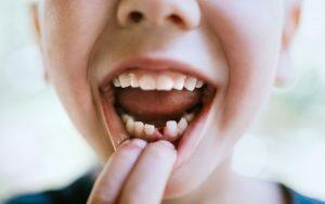 A young boy is inspecting his knocked-out tooth.