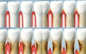 A series of images depicting the stages of a tooth and how dental care protects your respiratory system.