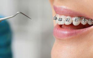 A woman experiences braces brackets falling off.