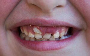 A close up of a child's mouth showing a missing baby tooth.