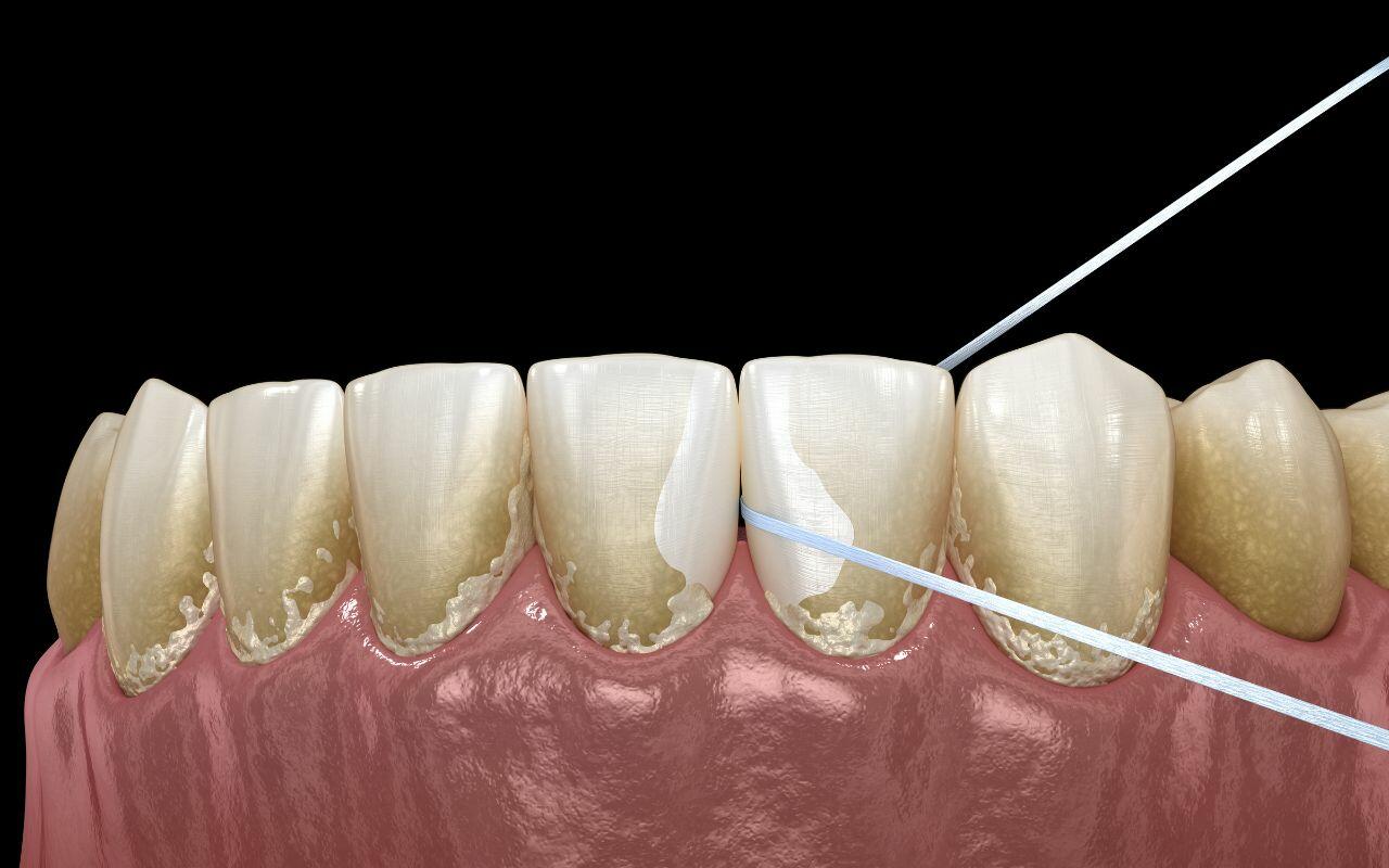 why-cant-i-get-my-teeth-as-smooth-as-my-dentist-does-after-a-dental-cleaning