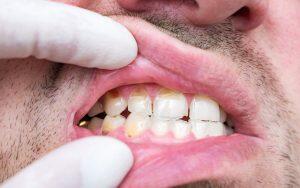 what-is-dental-erosion-sports-drinks-vs.-energy-drinks-and-your-teeth