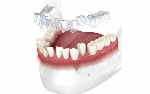 An illustration of a tooth with a dental implant.