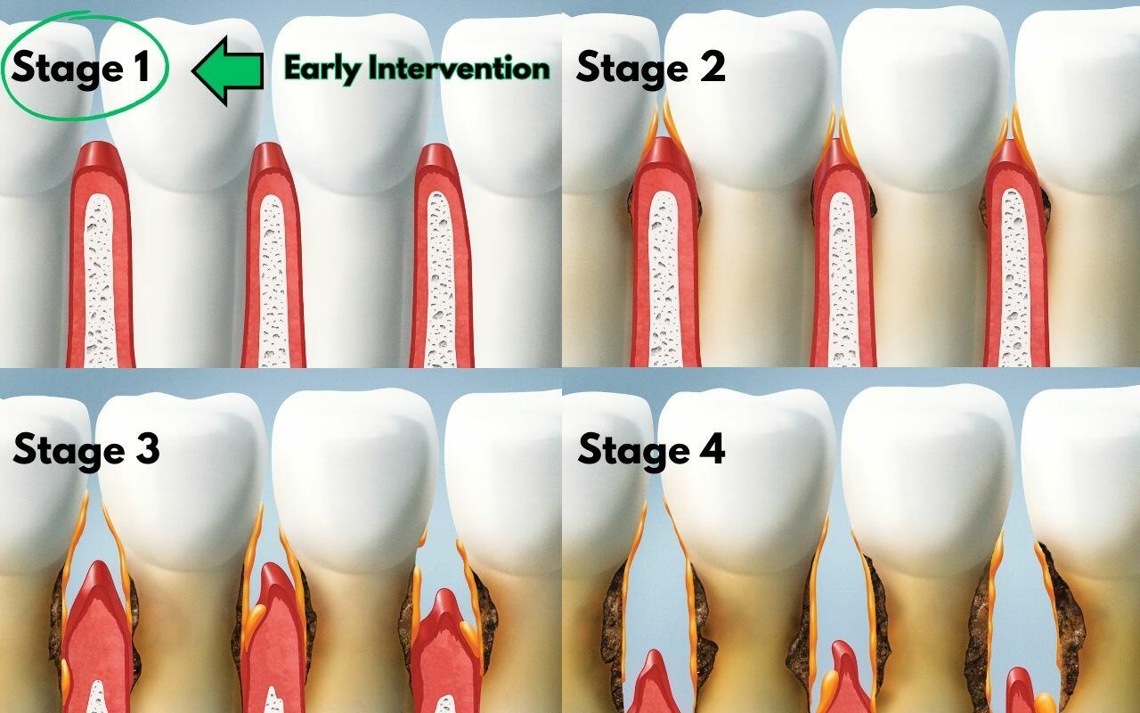 early-intervention-is-key