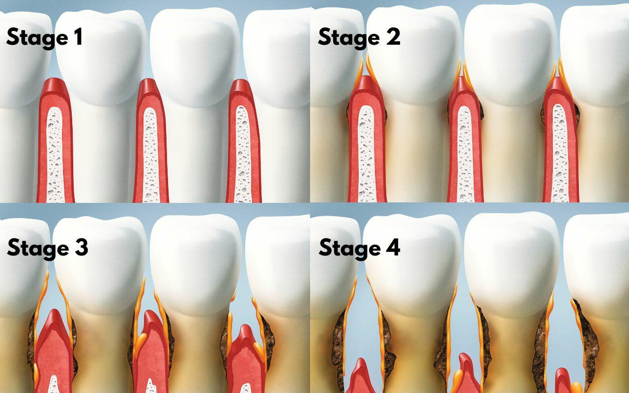 Stages of gum disease