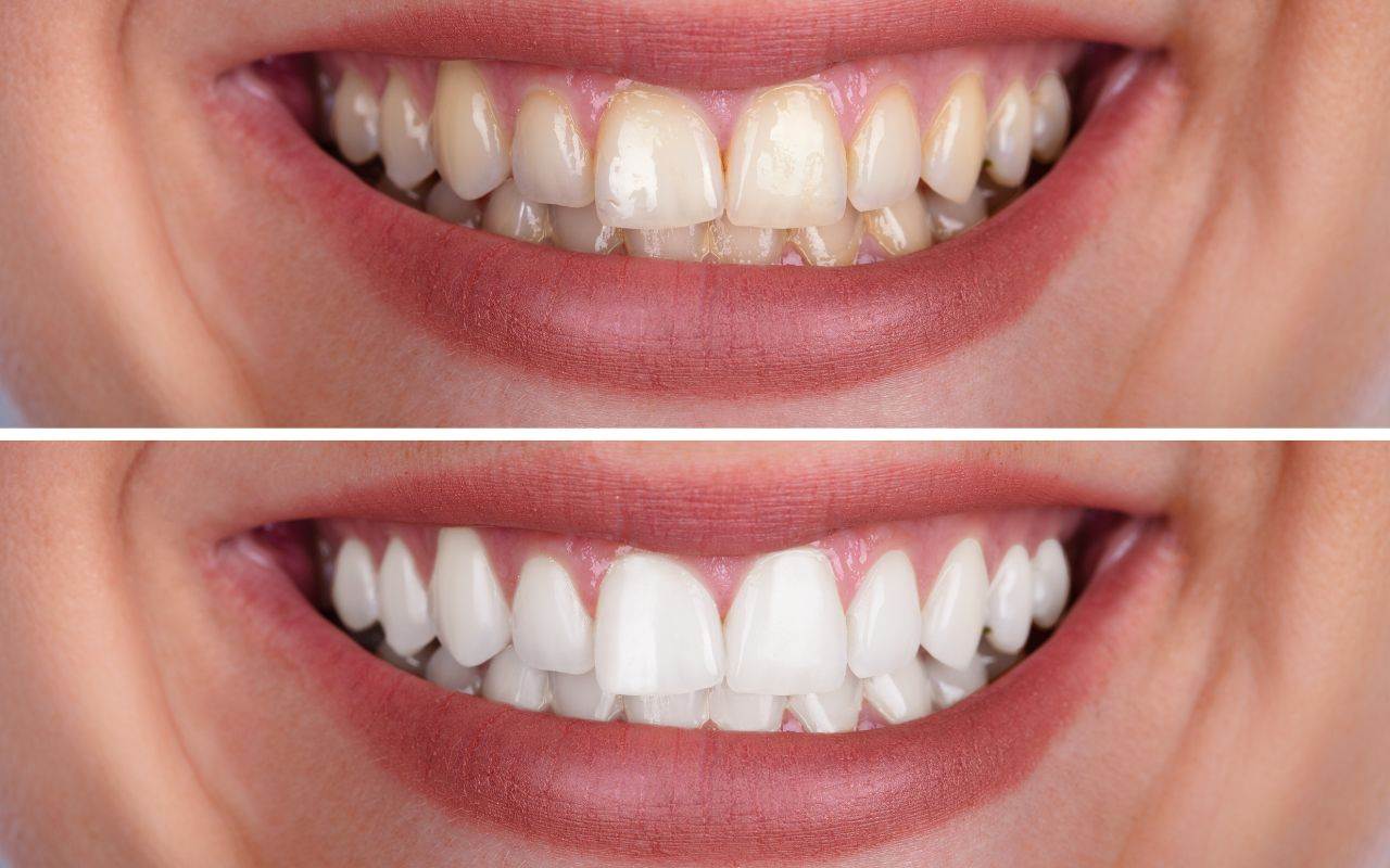 professional-teeth-whitening-pros-and-cons-Bradford-Family-Dentistry