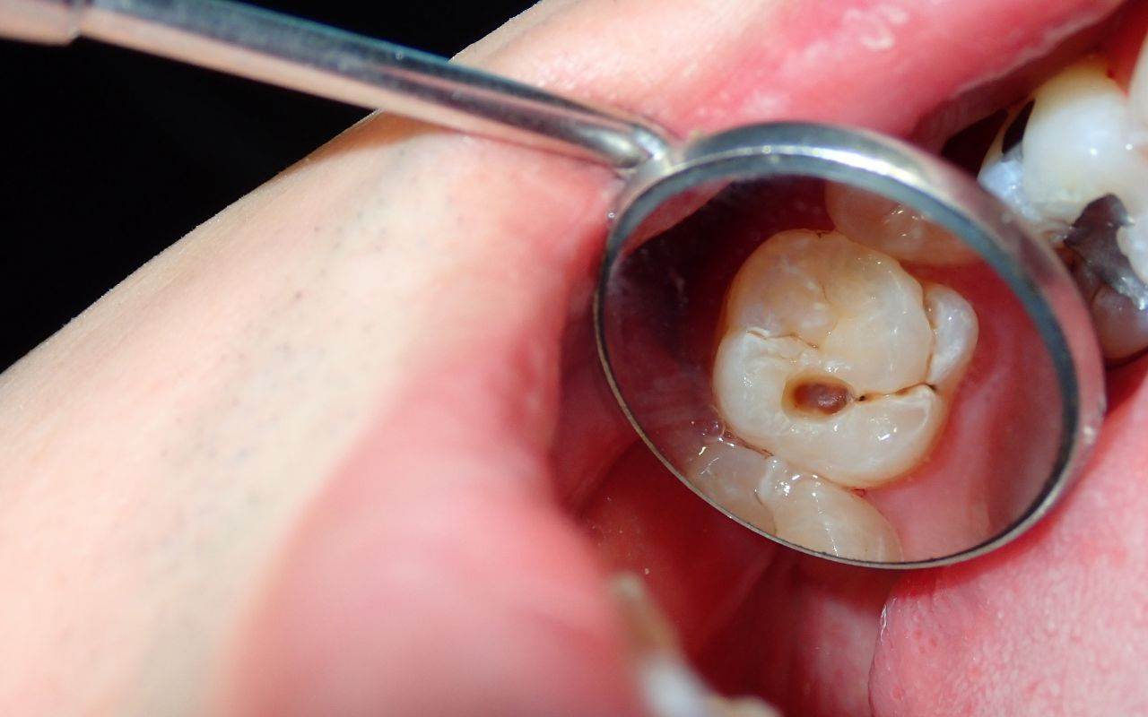 A close up of a tooth with a cavity in it.