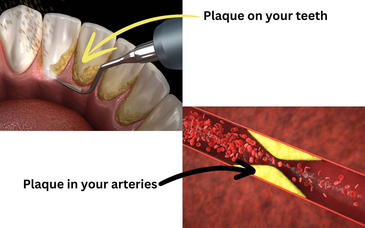 what-role-does-plaque-play-in-your-immune-system