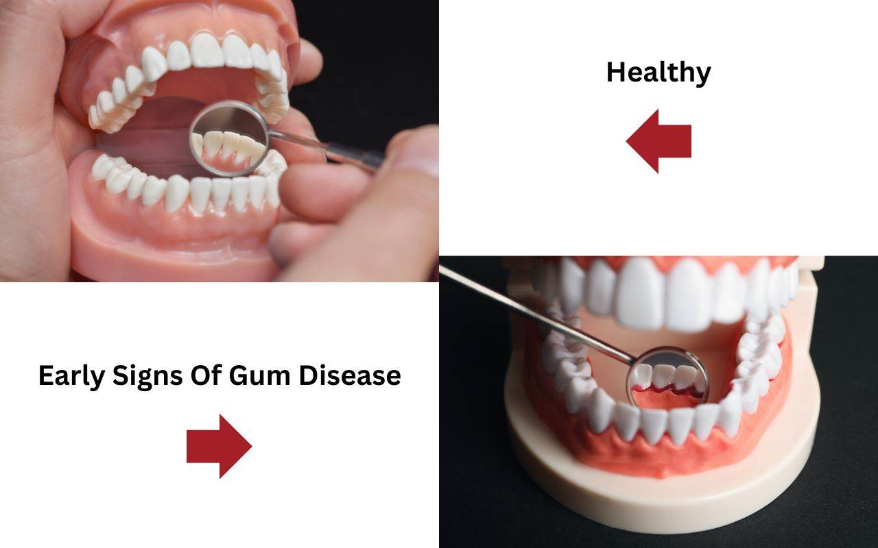 Early signs of gum disease.