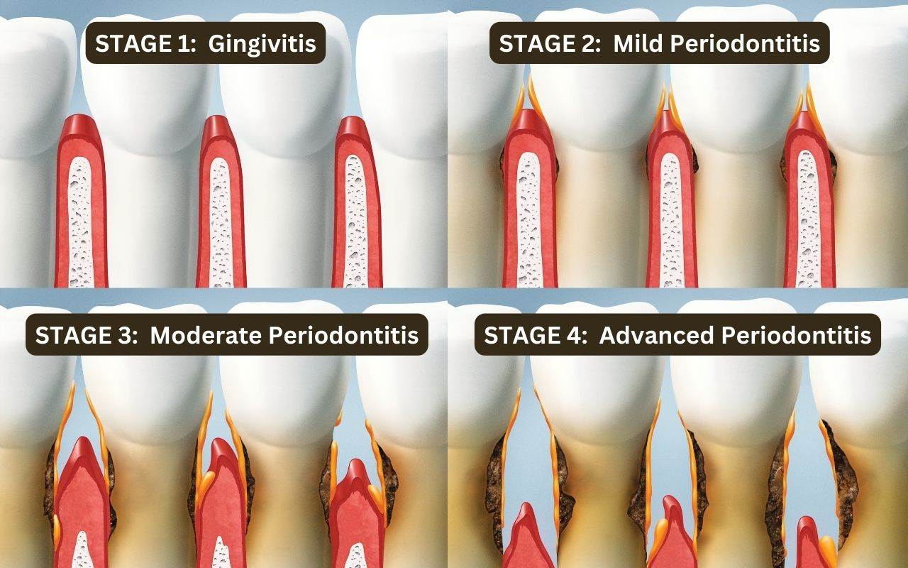 what-are-the-stages-of-gum-disease-can-you-have-gum-disease-and-not-know-it