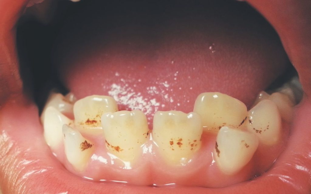 brown spots on teeth - intrinsic vs extrinsic stains - Bradford Family ...