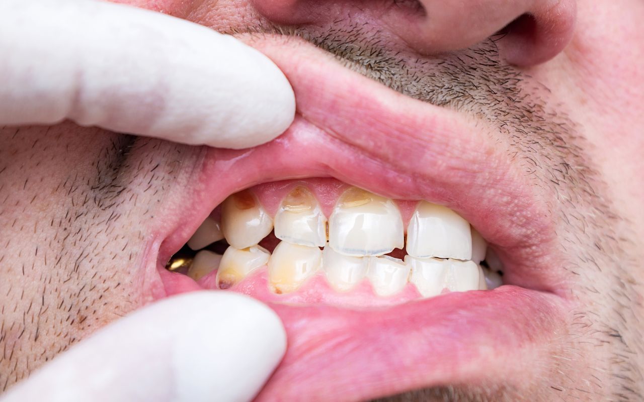 common-causes-of-brown-spots-on-teeth-enamel-hypoplasia