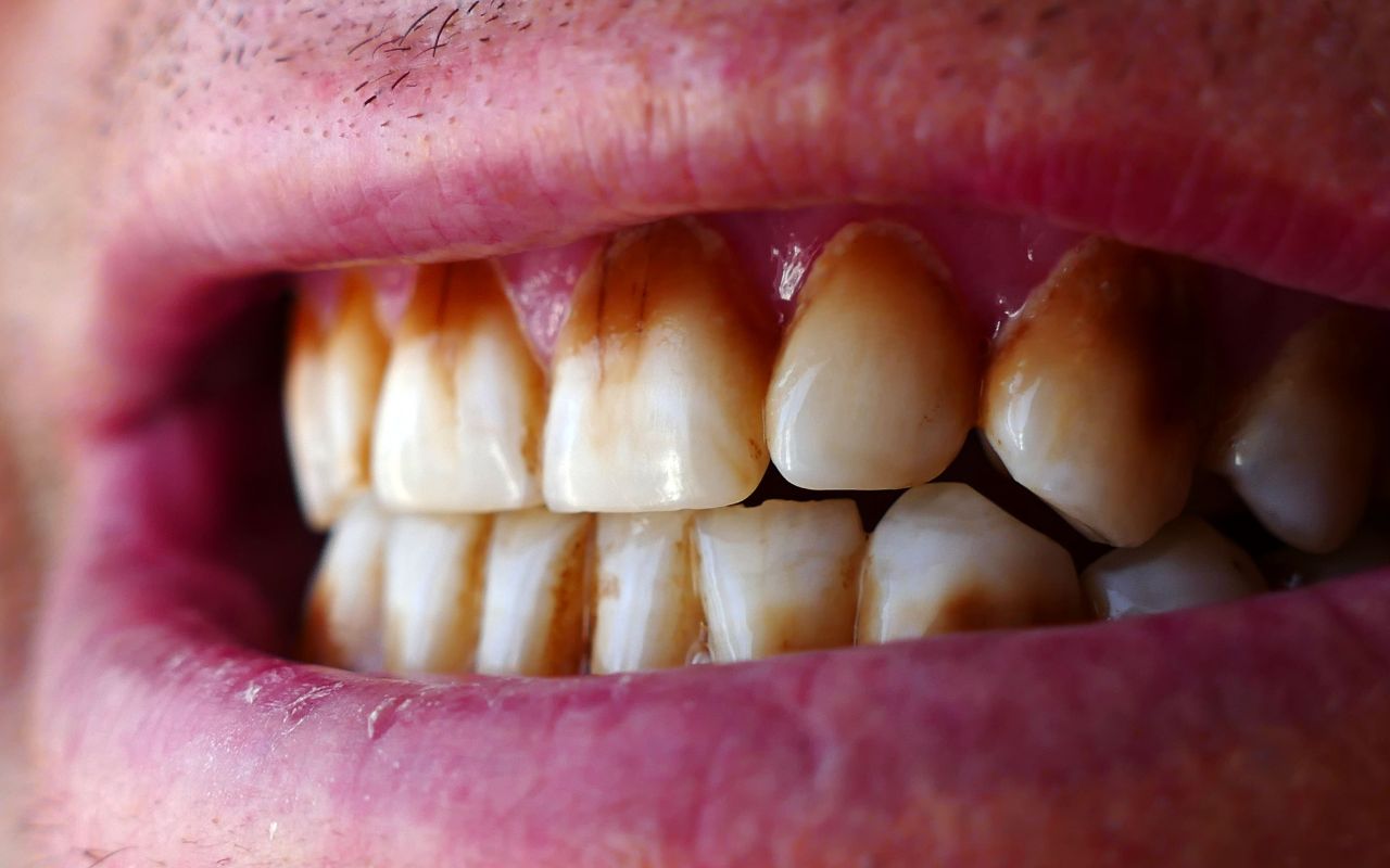 common-causes-of-brown-spots-on-teeth-nicotine