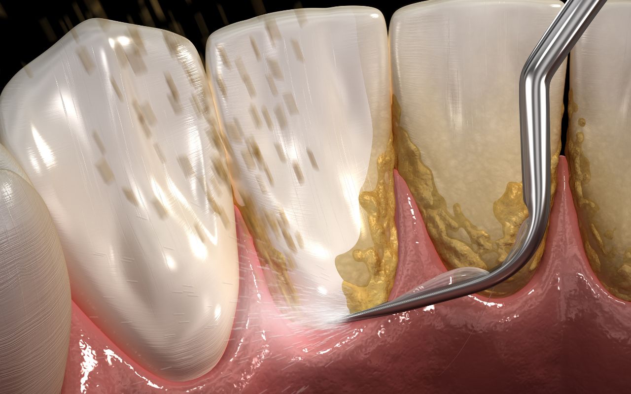 common-causes-of-brown-spots-on-teeth-tartar-and-plaque