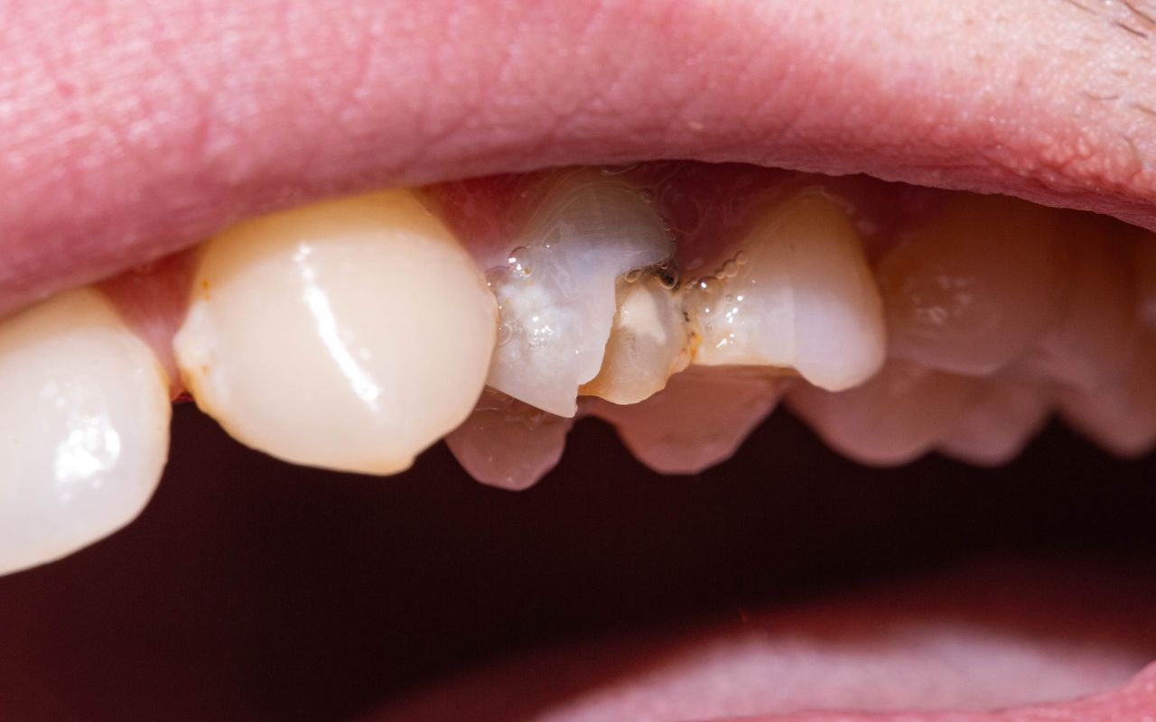 common-causes-of-brown-spots-on-teeth-tooth-trauma