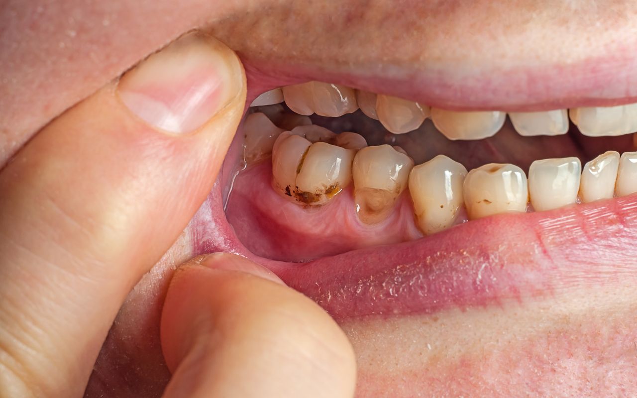 genetics-can-result-in-brown-spots-on-teeth