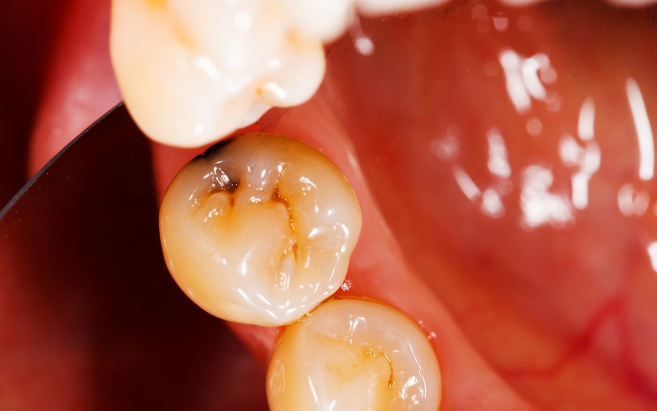 how-to-tell-if-brown-spots-are-a-cavity