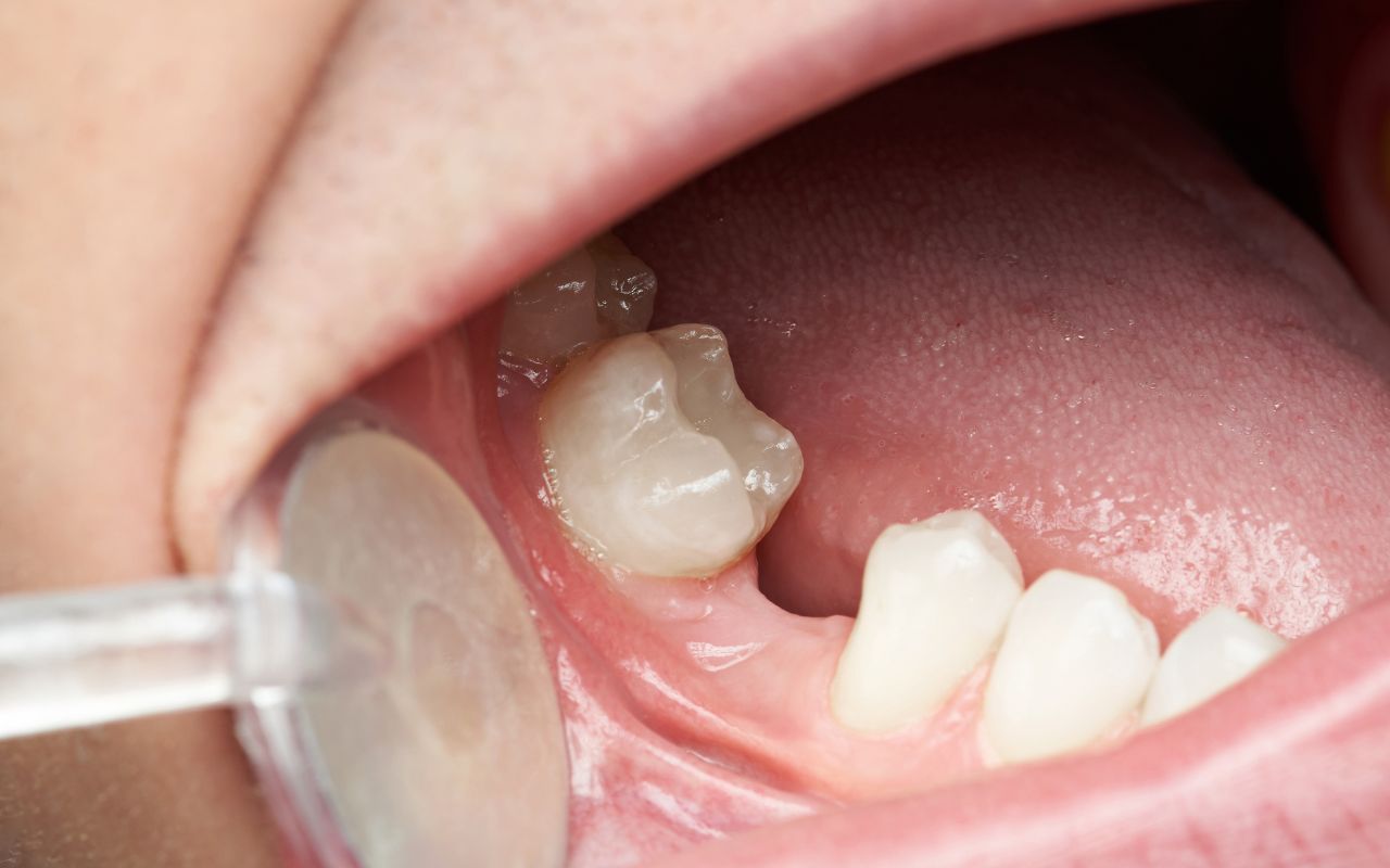 signs-you-might-need-dental-implants-you-dont-have-a-solution-for-missing-teeth