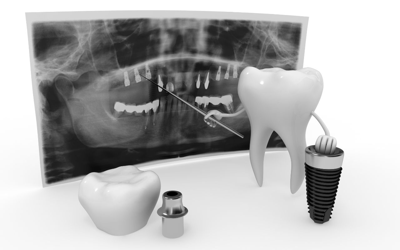 A 3D tooth character points to a dental x-ray with a stick. Nearby are a screw-like dental implant, its abutment, and another tooth.